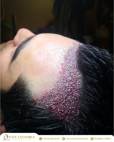 Slider image (1) Este Estanbul - Hair Transplant Clinic Istanbul, Turkey